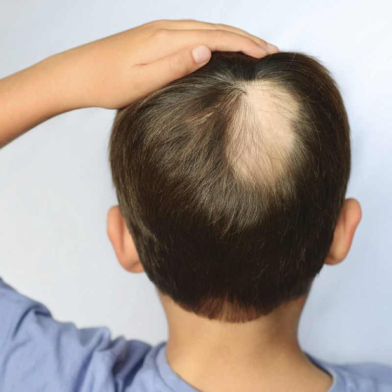 Alopecia nei bambini: nuove terapie disponibili